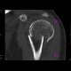 Fracture of humerus, comminuted: CT - Computed tomography